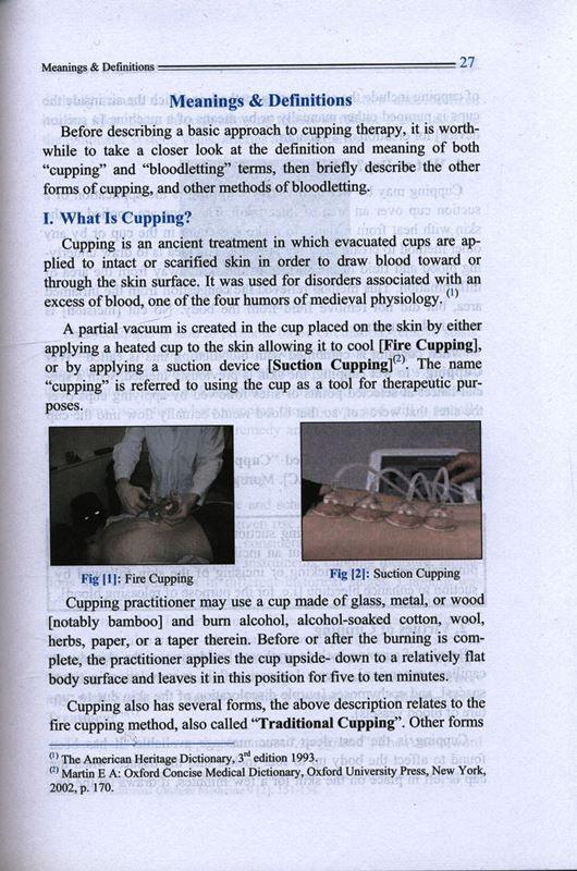 Cupping The Great Missing Therapy