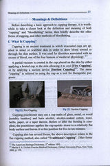 Cupping The Great Missing Therapy