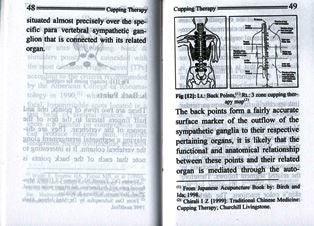 Cupping Therapy- The Ancient Art of Healing( Pocket Size)